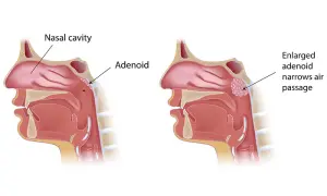 Adenoidectomy