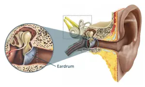 Myringoplasty