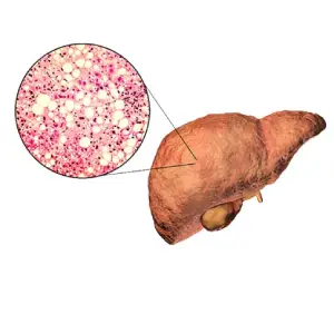 Fatty Liver