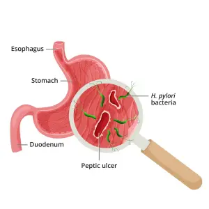 Peptic Ulcer Disease