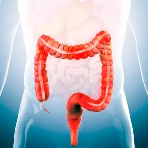Irritable Bowel Syndrome (IBS)