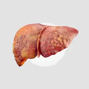 Cirrhosis