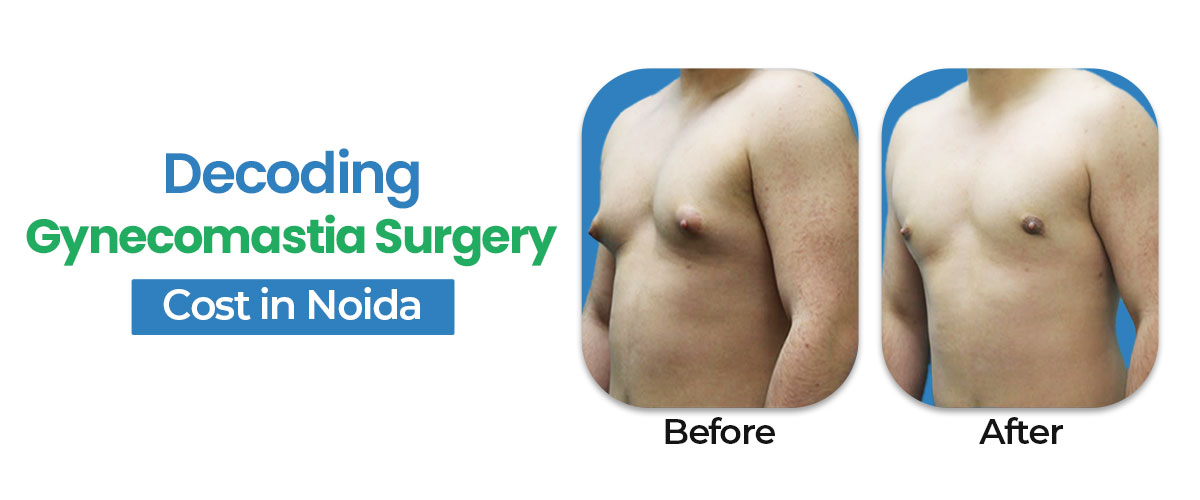 Decoding the Gynecomastia Surgery Cost in Noida