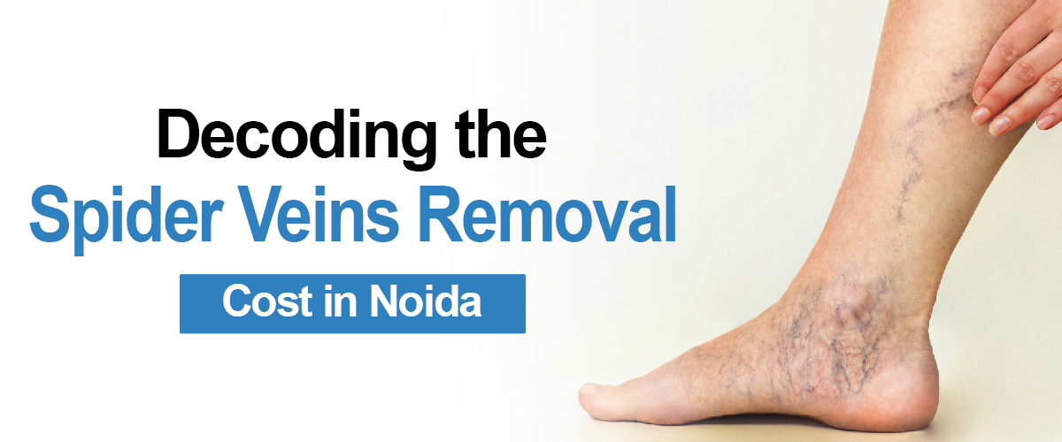 Decoding the Spider Veins Removal Cost in Noida