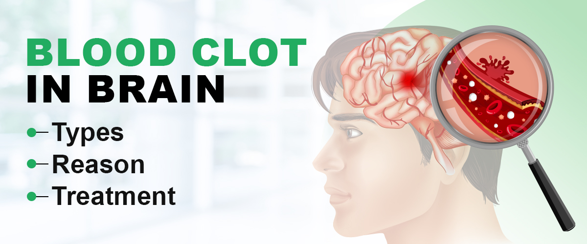 Blood Clot in Brain: Types, Reason & Treatment