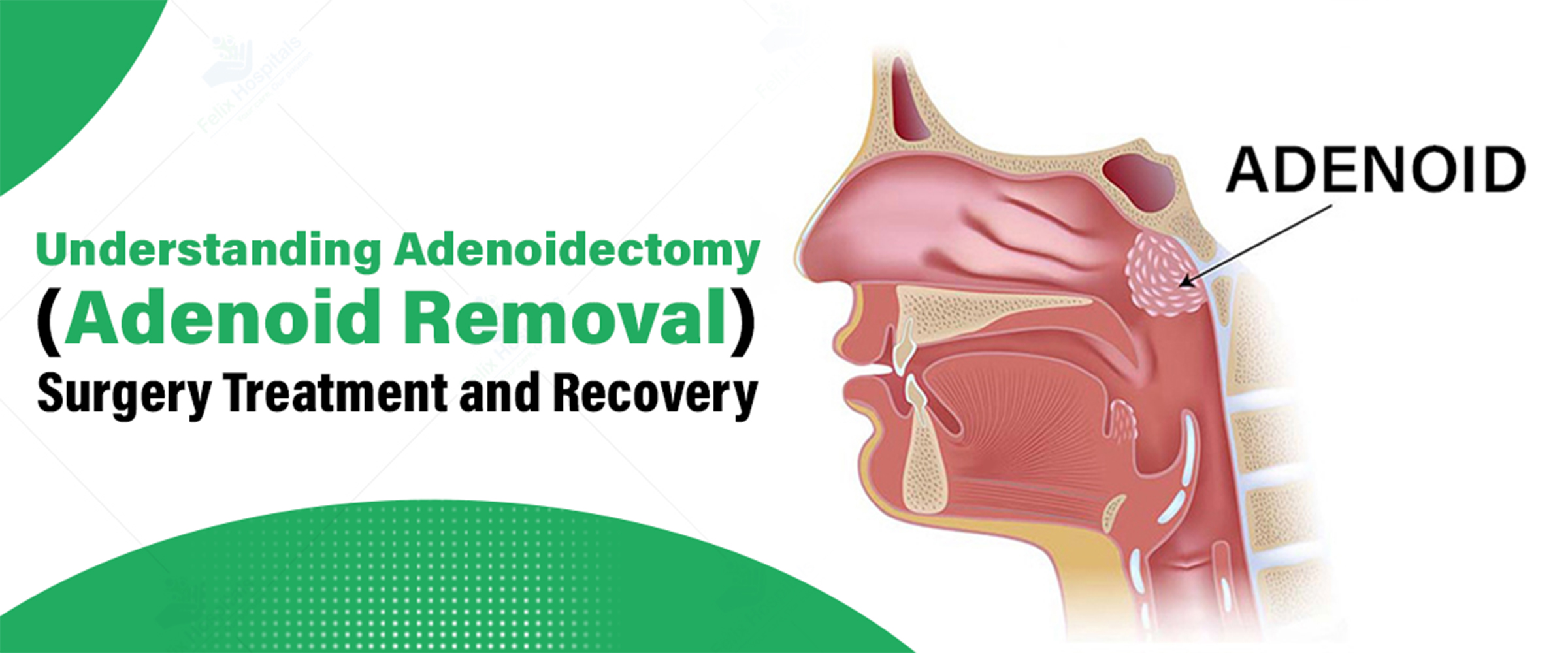 Understanding Adenoidectomy Adenoid Removal Surgery Treatment And 