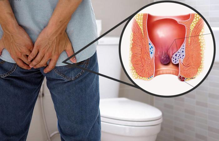 Best Piles Doctor in Noida