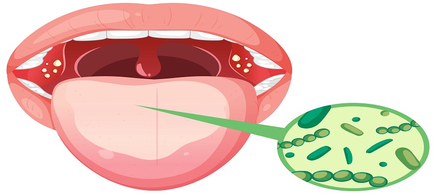 Chronic pharyngitis