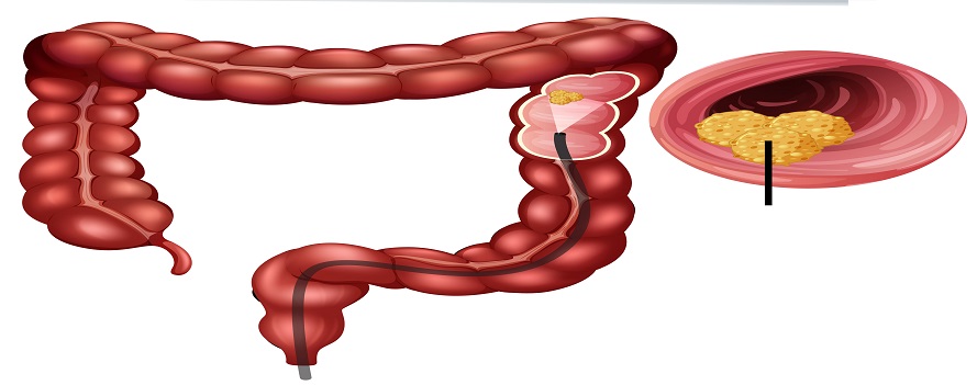 Common early signs of bowel cancer