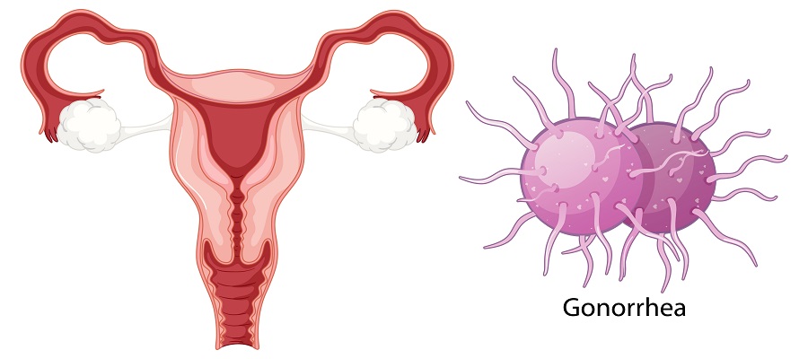 Understanding Gonorrhoeae: Causes, Symptoms, and Treatment