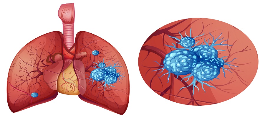 Lung Cancer - Symptoms, Causes, Treatment and Diagnosis