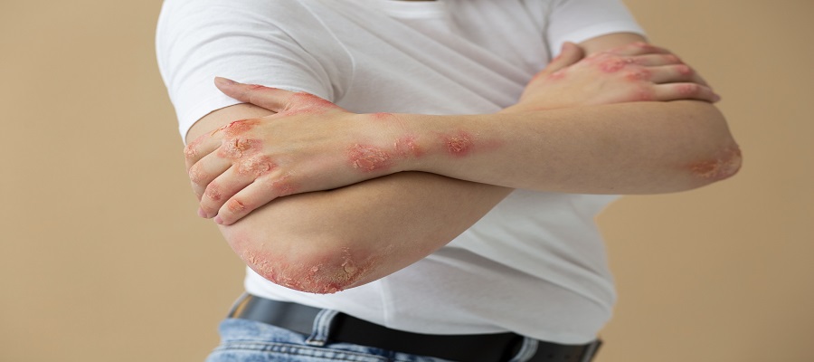Top 10 Common Fungal Infections and How to Treat Them