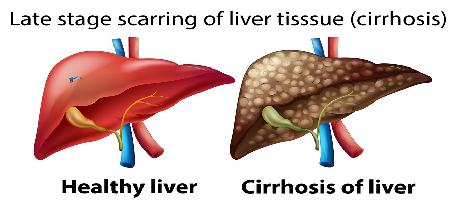Liver Cirrhosis
