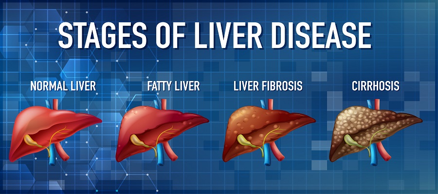 Stages of liver disease