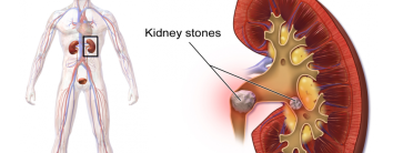 best-kidney-stone-removal-hospital-in-noida