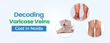 Varicose Vein Surgery Cost in Noida