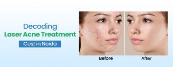 Laser Acne Treatment Cost in Noida