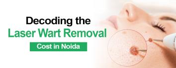 Laser Wart Removal Cost in Noida
