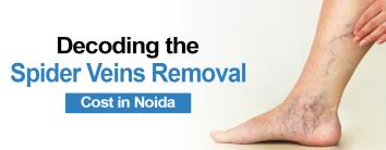 Spider Veins Removal Cost in Noida