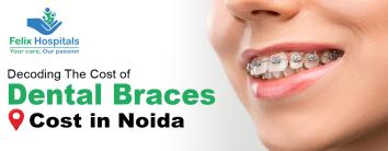Dental Braces Cost in Noida