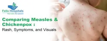Comparing Measles and Chickenpox