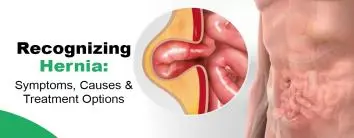 best hernia surgery in noida