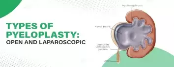 Types of Pyeloplasty