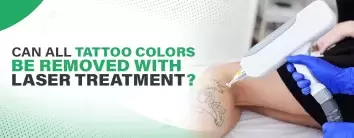 Can All Tattoo Colors Be Removed with Laser Treatment?