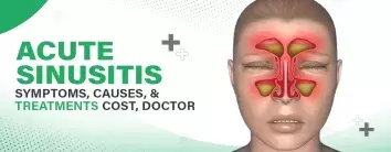 Acute Sinusitis: Symptoms, Causes, Treatments, Cost, and Doctor