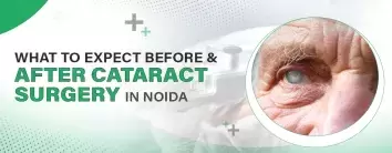 Cataract Surgery in Noida