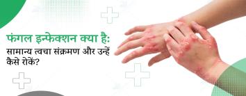 फंगल इन्फेक्शन क्या है?