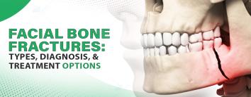 Facial Bone Fractures