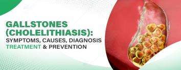 Gallstones (Cholelithiasis): Symptoms, Causes, Diagnosis, Treatment & Prevention
