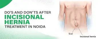 Incisional Hernia Treatment in Noida