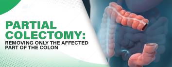 Partial Colectomy: Removing Only the Affected Part of the Colon