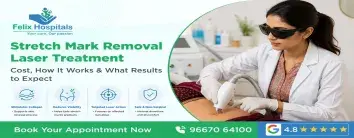 price of laser treatment for stretch marks